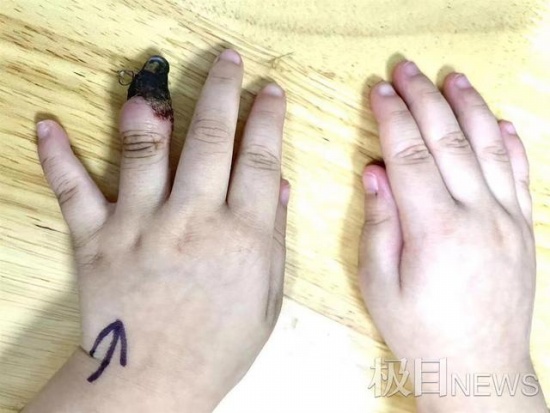 家人錯誤包扎致3歲女童手指壞死